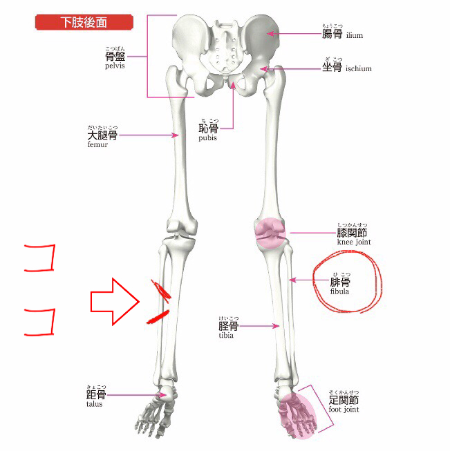 腓骨骨折 トーラス整体